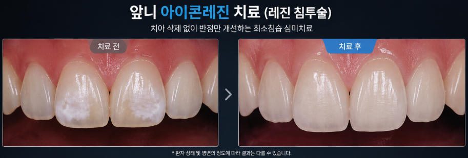 앞니 아이콘 레진치료 전후