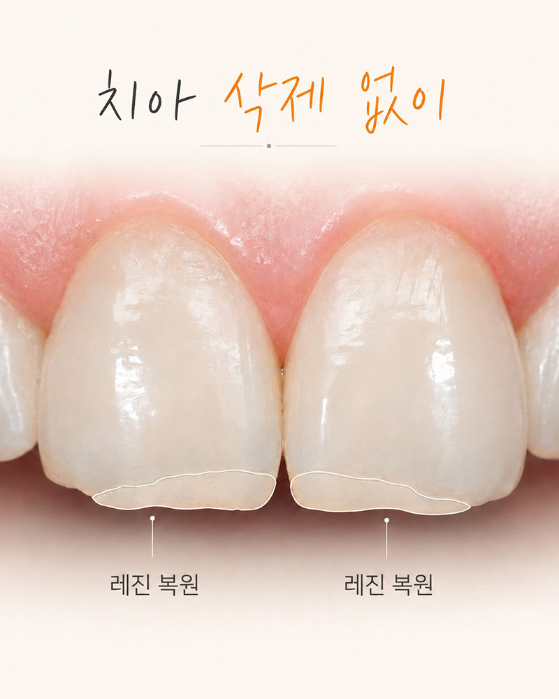레진비니어 장점